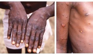 Virus monkeypox penyakit cacar monyet yang pertama kali muncul di Singapura